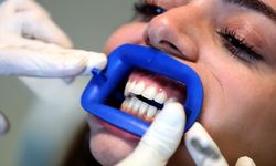 Diş beyazlatmak isterken sağlığınızdan olmayın: Uzmanından kritik uyarılar
